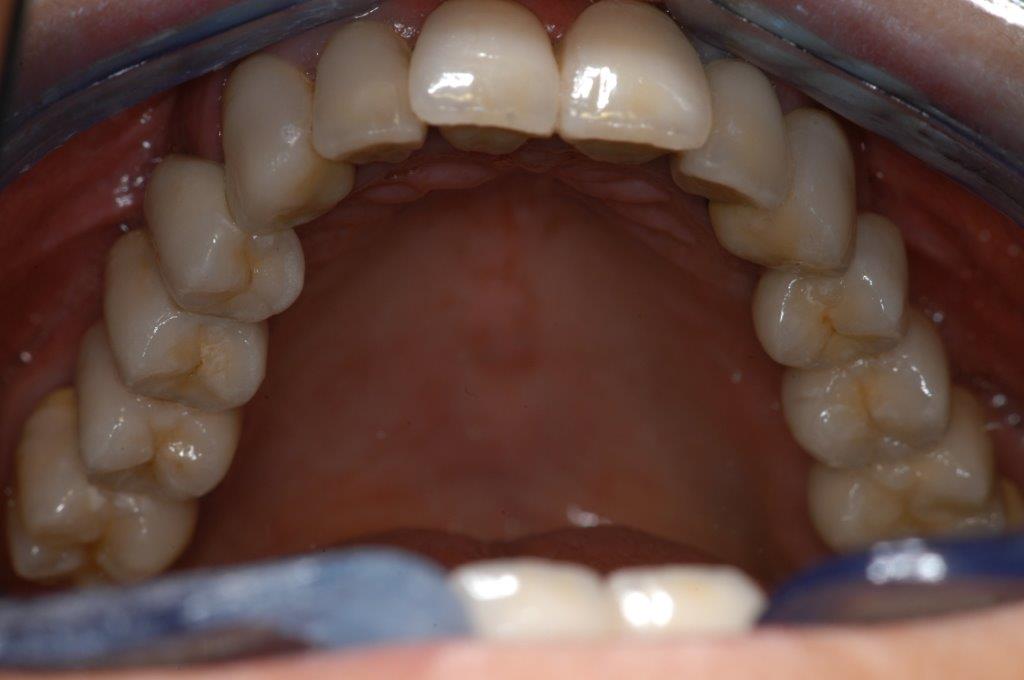 Arcata superiore in Art Oral KM - Fabiano Bolzani