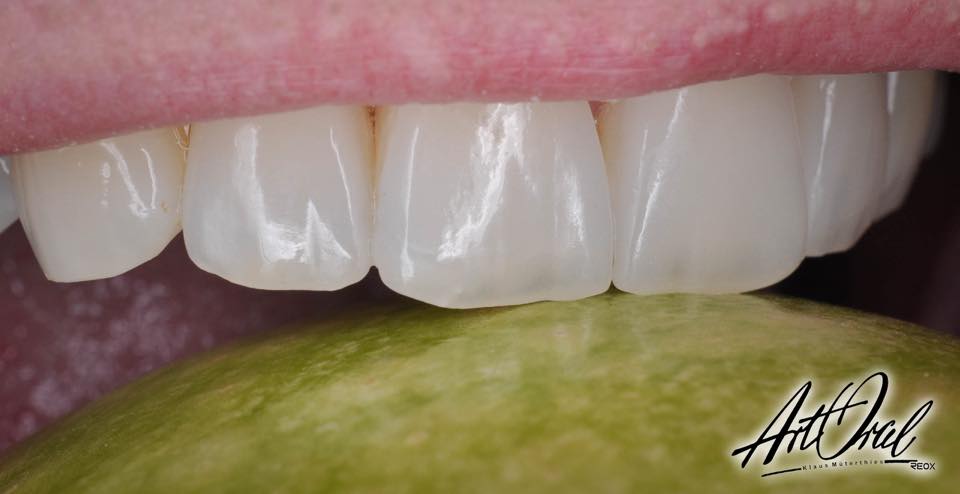 No prep Veneers - Elīna Rubeze-Upīte - Latvia 