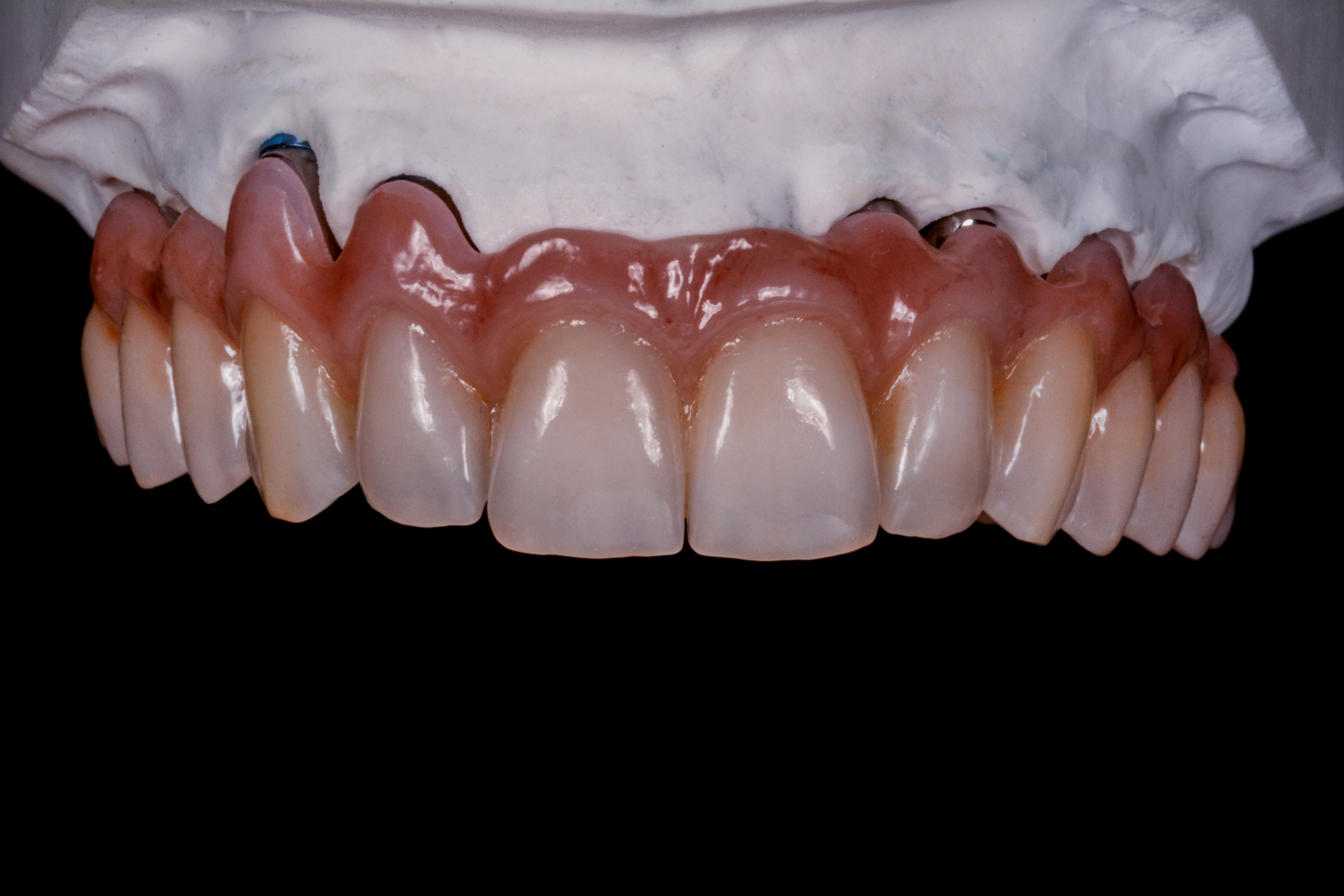 Toronto in zirconio ceramica su barra in metallo - Stefano Mazzarella